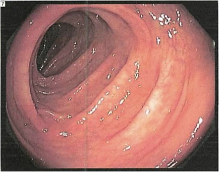 How do you cleanse your colon before a colonoscopy?