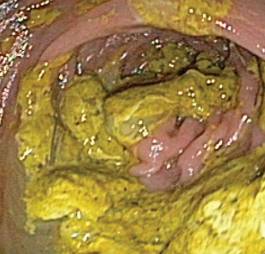 Bad Colon Prep