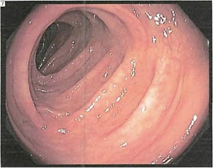 Good Colonoscopy Prep